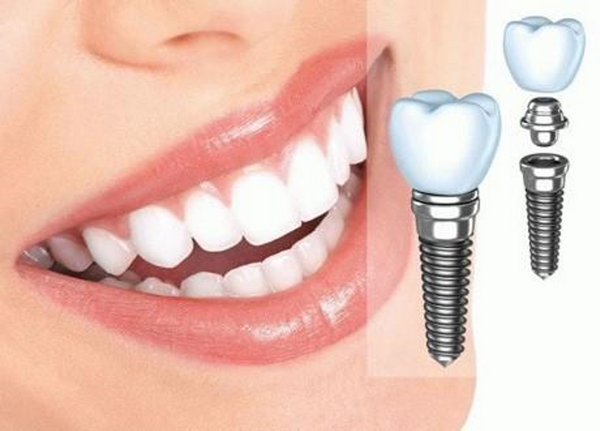 Способы имплантации зуба