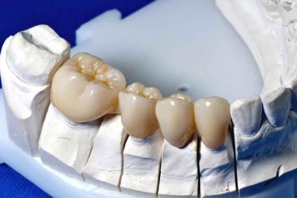 Зубной мост на жевательные зубы