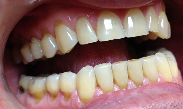 Клиновидный дефект представляет собой поражение твердых тканей зубов некариозной этиологии