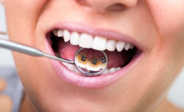 Брекет-системы – это ортодонтические конструкции, которые предназначены для выравнивая зубного ряда