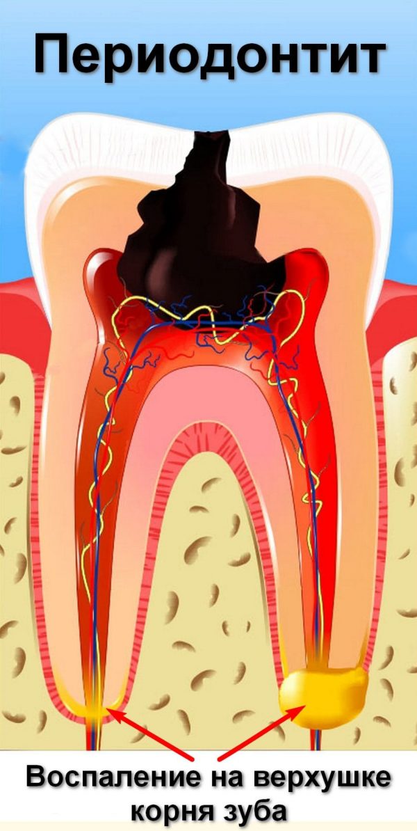 Осложнение кариеса с воспалительными изменениями в области околокорневых тканей зуба