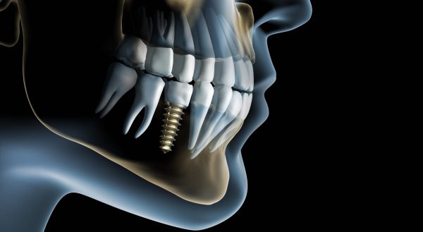 Протезирование при отсутствии одного зуба