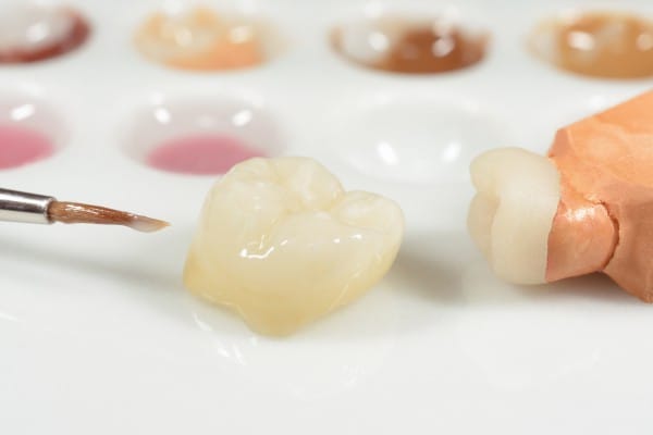 Протезирование зубов вкладками позволяет свести к практическому минимуму зазор между вкладкой и зубными тканями
