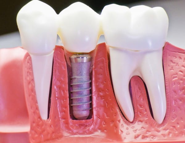 Применение протеза на имплантате позволит полноценно использовать искусственный зуб
