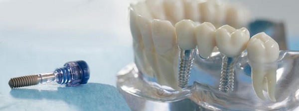 3D-имплантация зубов