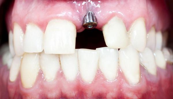 Как проходит имплантация верхних зубов