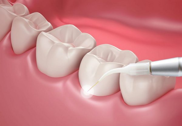 5 причин выбрать лазер для лечения зубов