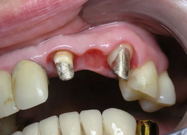 Лечение и протезирование жевательных зубов