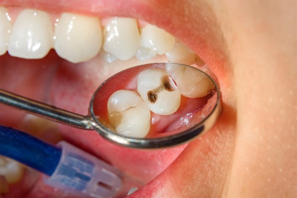 Лечение кариеса верхних зубов