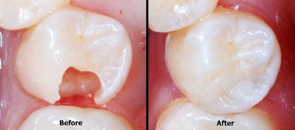 Лечение жевательных зубов