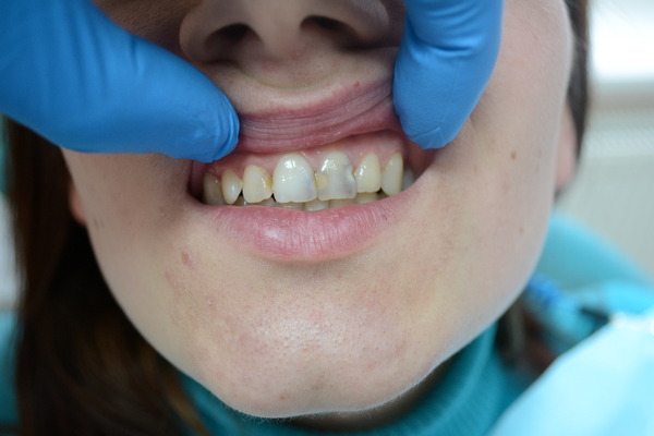 Начальная стадия кариеса передних зубов