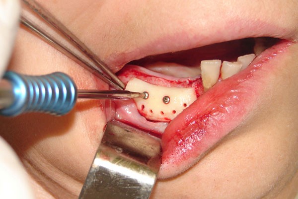 Наращивание кости перед имплантацией нижних зубов