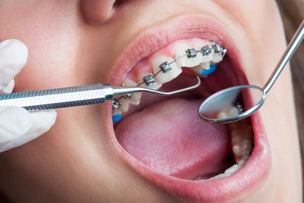 Ортодонтическое лечение зубов у взрослых пациентов