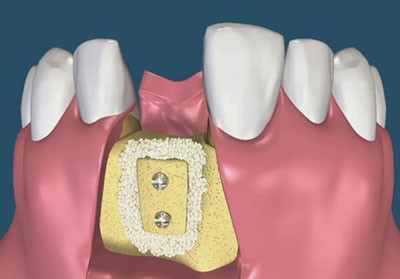 Подсадка костного блока при имплантации зубов