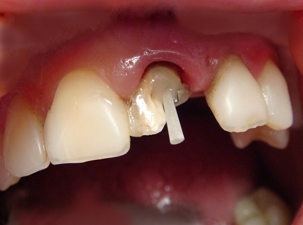 Протезирование жевательных зубов