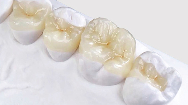 Реставрационные вкладки для восстановления жевательных зубов