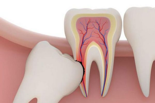 Стоит ли лечить зубы мудрости?