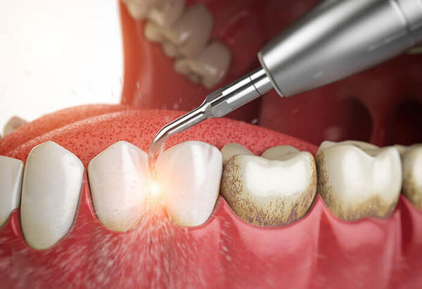Терапевтическое лечение десен зубов