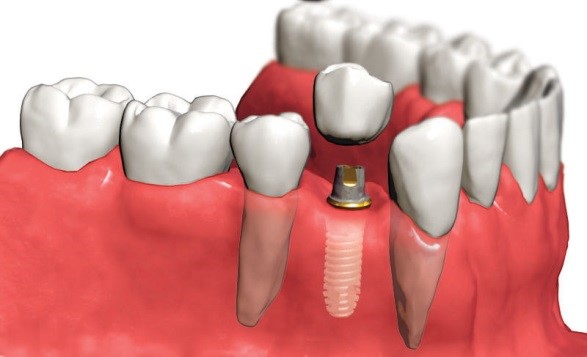 Восстановление после имплантации нижних зубов