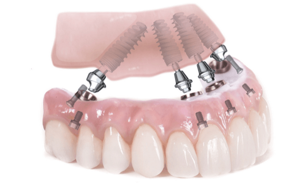 Имплантация зубов по концепции all-on-4