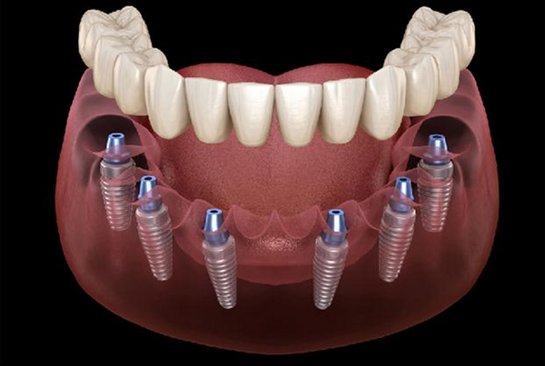 Имплантация зубов по методу all-on-6