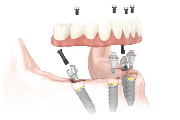 Имплантация зубов по протоколу all-on-4