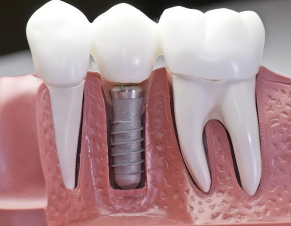 Осложнения после имплантации зубов
