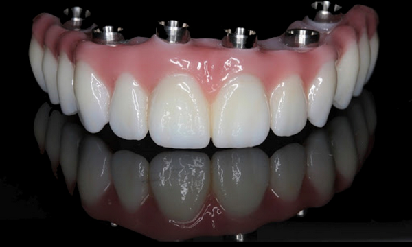 Особенности протезирования при имплантации зубов all-on-6