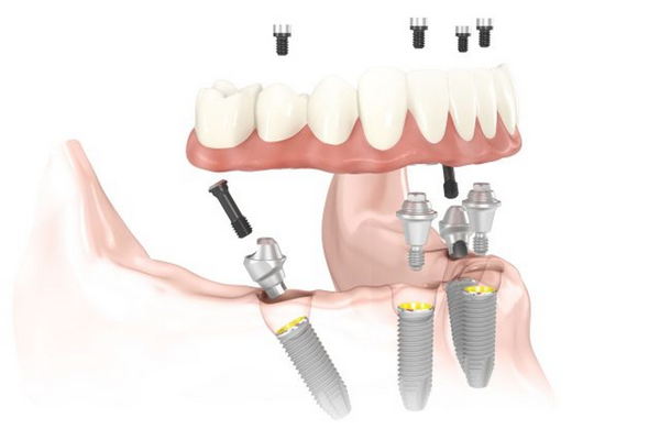Особенности протезирования зубов на имплантах