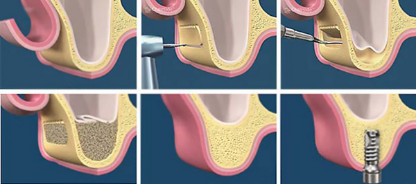 Открытый синус-лифтинг при имплантации зуба