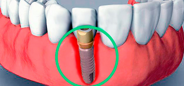Отторжение конструкции при имплантации зубов