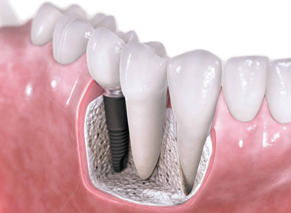 Пластика при имплантации зуба