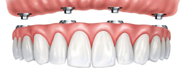 Преимущества имплантации зубов перед другими методами