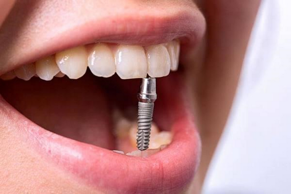 Ранние осложнения имплантации зубов