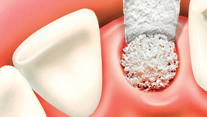 Синус-лифтинг при имплантации зубов