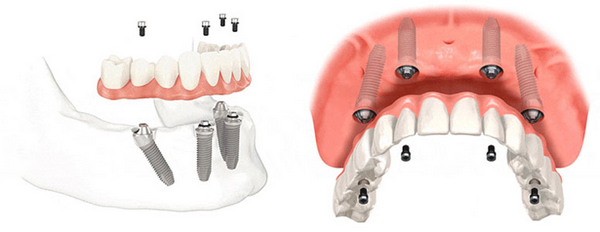 Условия и требования для успешной имплантации при отсутствии зубов