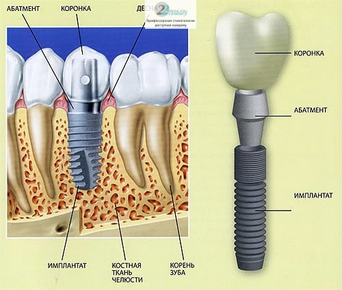 Что представляет собой имплантация зубов