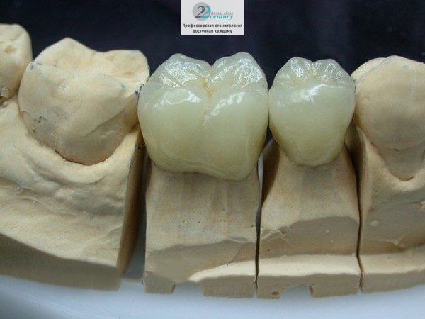 Коронка из металлокерамики на нижние жевательные зубы