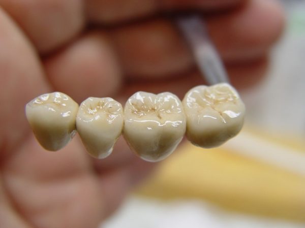 Зубные мосты из металлокерамики