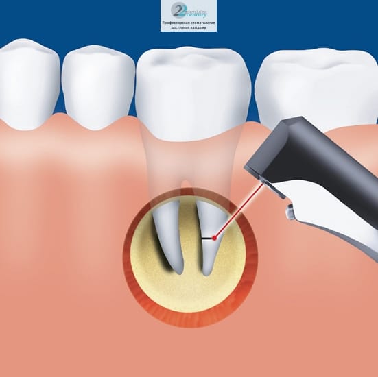 Гемисекция корня зуба – процедура, в процессе которой удаляется пораженный корень одновременно с частью зуба