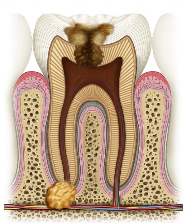 Киста зуба – это небольшое образование в области его корня, имеющее воспалительный характер