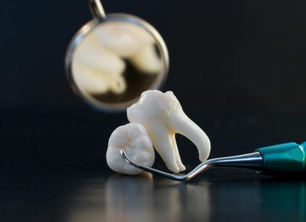 Мы проводим операции по удалению зубов любой сложности