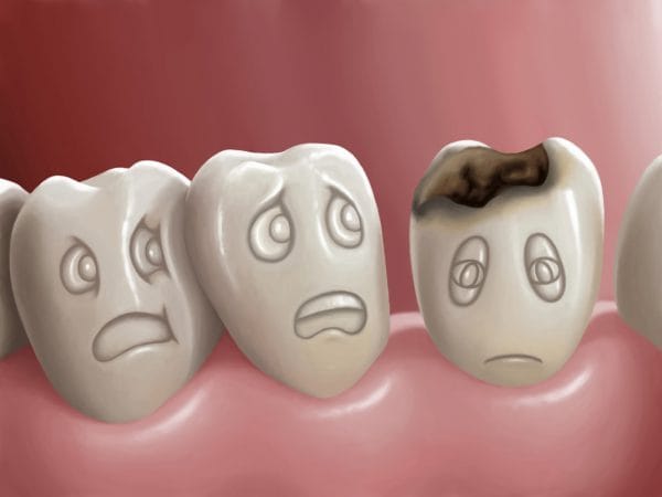 Вредные вещества, повреждающие наши зубы, образуются особыми кариесогенными бактериями, проживающими в полости рта и концентрирующимися в зубном налете