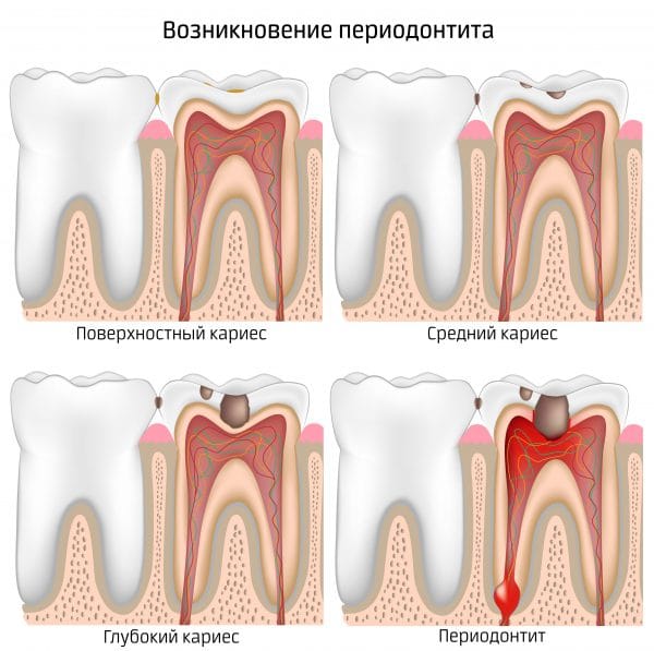 Когда воспалительный процесс переходит с пульпы на верхушку зубного корня, поражая окружающую его ткань, возникает периодонтит