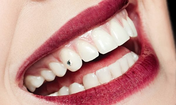 Зубные украшения на сегодняшний день широко применяются в стоматологии и пользуются большой популярностью