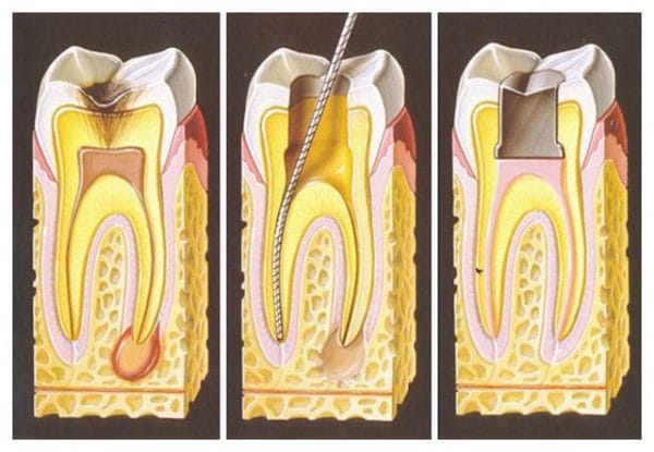 На сегодня единственно возможный способ лечения гангренозного пульпита — это пульпэктомия, в ходе которой пульпа полностью удаляется из пораженного зуба, с последующим пломбированием каналов зуба