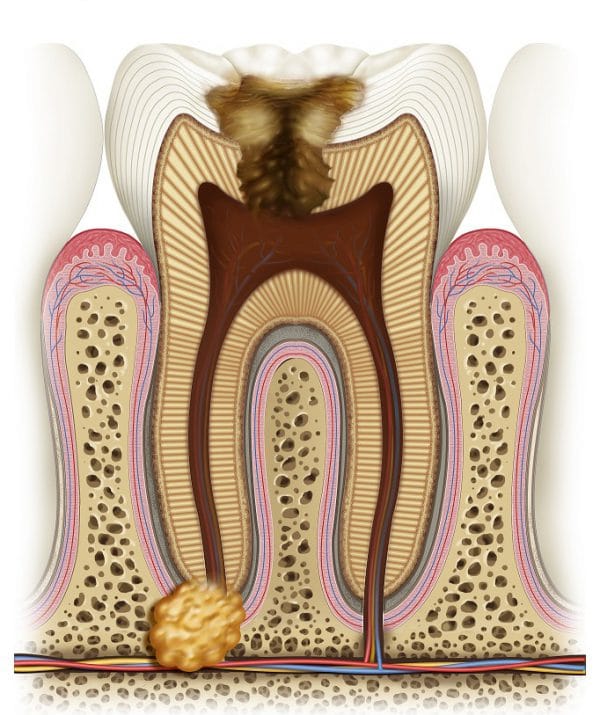 Острый диффузный пульпит — часто встречающееся заболевание, представляющее собой воспаление, начинающееся с сосудисто-нервного пучка зуба