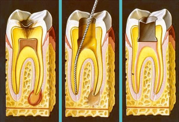 Лечение фиброзного пульпита - эта процедура довольно сложная, сегодняшними методами лечения пульпита зуб можно сохранить