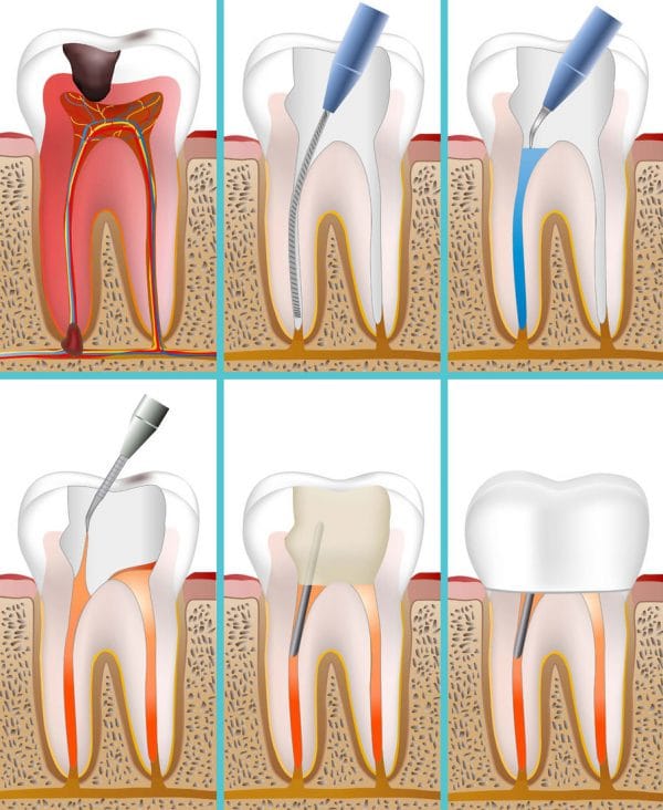 На первом этапе производится удаление кариеса, пульпы (“нерва”) зуба, тщательно очищаются каналы зуба
