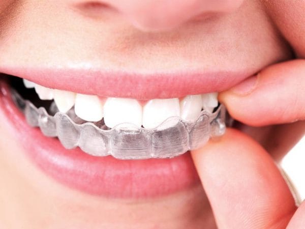 Капа для зубов – прозрачная съемная конструкция, которая оказывает механическое воздействие на зубы